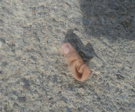 В Ростовской области парню оторвало палец во время занятий на турнике