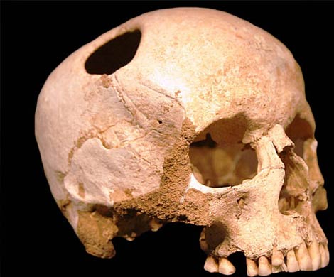 В Сибири 3000 лет назад проводили трепанацию черепа