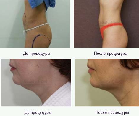 Криолиполиз: ударим холодом по жировым отложениям