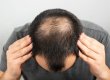 Лысина не приговор, оказалось, что дешевый природный сахар сравнился по эффекту с дорогим препаратом