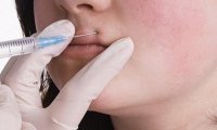 14-летние подростки все чаще увеличивают губы, несмотря на серьезные риски