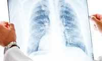 8 самых распространенных симптомов рака легких
