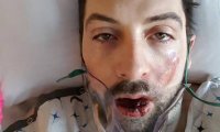 Американец потерял семь зубов из-за взорвавшейся электронной сигареты