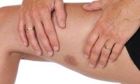 Часто появляющиеся синяки не представляют опасности