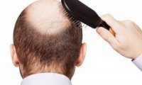 Генетики выяснили главную причину мужского облысения‍