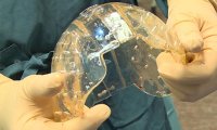 Имплантаты, распечатанные на 3D-принтере, помогли выжить детям