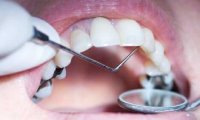 Испанские стоматологи могут диагностировать кариес задолго до первых симптомов