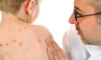 Корь добралась до России: как не стать жертвой опасной инфекции