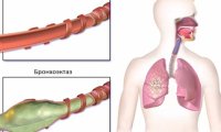 Лечение бронхоэктаз: современные способы