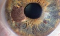Меланома может появиться не только на коже, но и в глазах