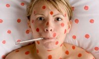 На Украине могут объявить эпидемию кори