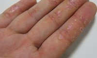Причины и механизм развития экземы на руках