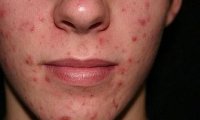 Прыщи на лице становятся заметнее из-за курения