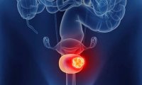 Рак мочевого пузыря: особенности заболевания и его лечение в Германии