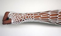 Российские инженеры вылечат перелом с помощью 3D-принтера  