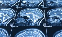 Сканирование мозга определит, насколько необходима человеку психотерапия