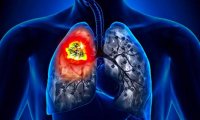 Смертность от рака продолжает снижаться благодаря прогрессу в раннем выявлении и лечении рака легких