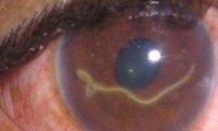 В Тамбове врачи удалили тропического червя из глаза пациентки