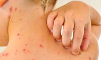 Заболеваемость корью в России выросла почти в 4 раза