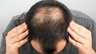 Лысина не приговор, оказалось, что дешевый природный сахар сравнился по эффекту с дорогим препаратом