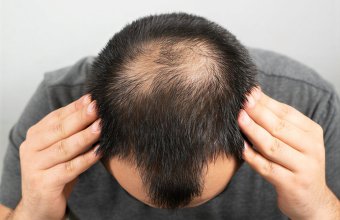 Лысина не приговор, оказалось, что дешевый природный сахар сравнился по эффекту с дорогим препаратом