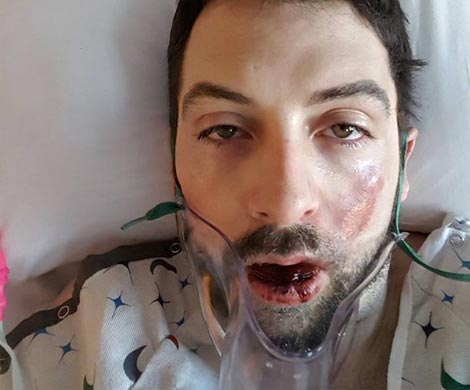 Американец потерял семь зубов из-за взорвавшейся электронной сигареты