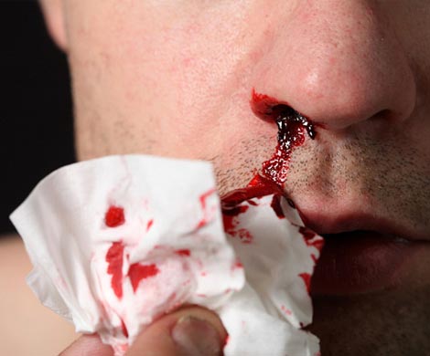 Американские врачи сообщили, как устранить кровотечения из носа