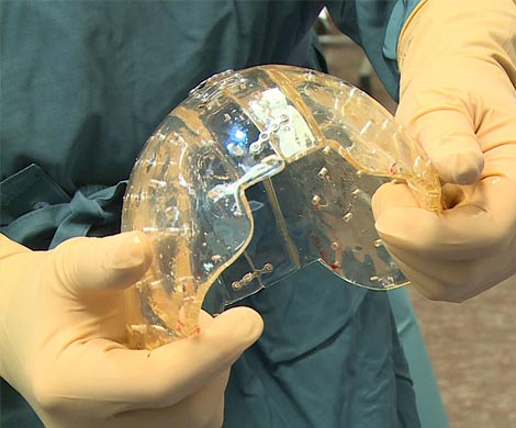 Имплантаты, распечатанные на 3D-принтере, помогли выжить детям