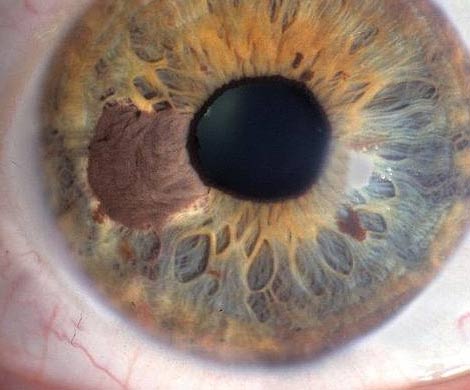 Меланома может появиться не только на коже, но и в глазах