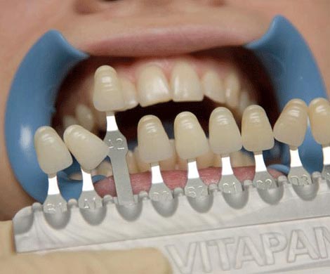 Назван ТОП-5 продуктов, которые ухудшают цвет зубов