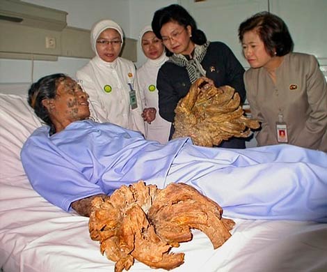 Редкое заболевание превращает жителя Индонезии в дерево