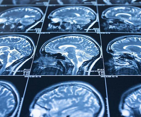 Сканирование мозга определит, насколько необходима человеку психотерапия