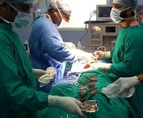 В Индии врачи извлекли из желудка мужчины десятки ножей