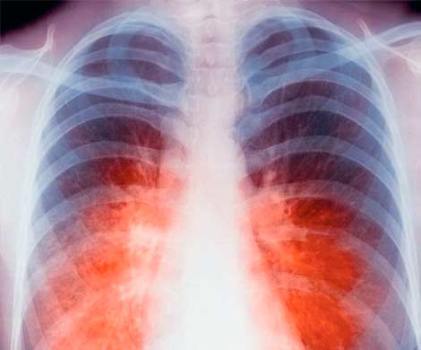 В 2013 году 9 млн человек заразились туберкулезом