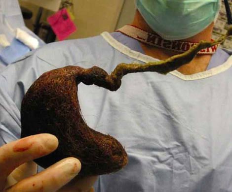 Хирурги обнаружили в кишечнике девочки огромный комок волос